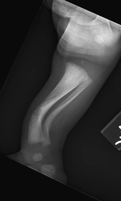 Posteromedial Bowing Of The Tibia | Pediatric Orthopaedic Society Of ...